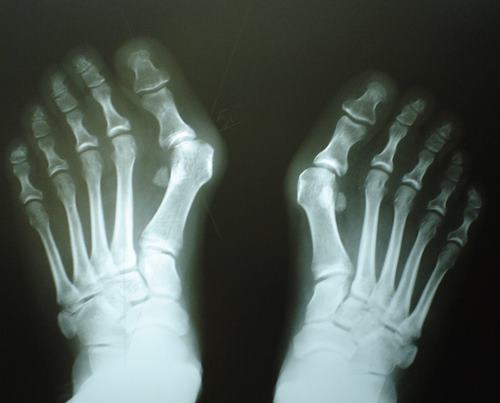 ALLUCE-VALGO-CASO-CLINICO-PRE-OPERATORIO