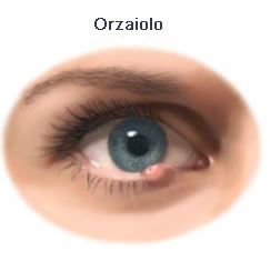 orzaiolo